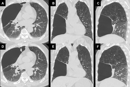 Figure 1 (A–C) High resolution computed tomography (HRCT) taken before the procedure (Horizontal axis, coronal, sagittal, respectively) indicates severe emphysema and a giant bulla in the right middle lobe. (D–F) HRCT taken at 1st day after the procedure showing the decrease of the bulla and the re-expansion of the adjacent lobe.