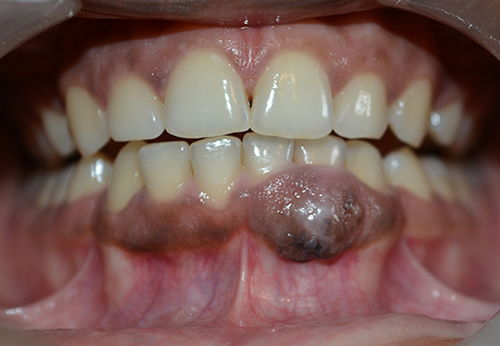 Figure 1 Pre-operative photograph of gingival enlargement.