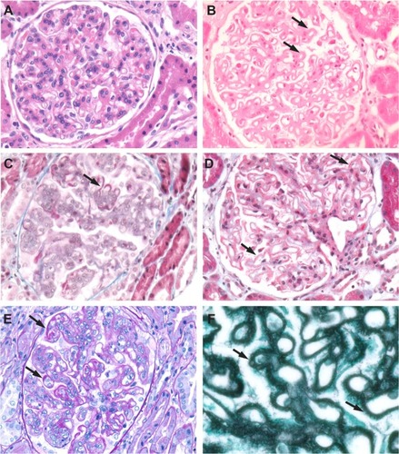 Figure 10 Class V lupus nephritis. Histological special stains are useful for further delineating the extent of glomerular deposits. (A) H&E-stained section of a Class V case showing mesangial hypercellularity. (B) H&E-stained section from a Class V case showing heavy deposits in the mesangium and capillary loops (arrows). (C) Fuchsinophilic deposits (arrows) on capillary loops seen in a Masson’s trichrome-stained section. (D) Deposits (arrows) in a Masson’s trichrome-stained section. (E) Deposits (arrows) seen in a PAS-stained section. (F) Basement membrane “spikes” in capillary loop deposits (arrows) seen in a methenamine silver-stained section.