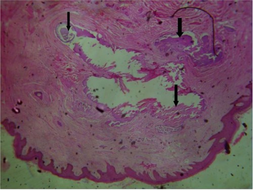 Figure 3 Photomicrograph of a case of idiopathic scrotal calcinosis showing nodules of calcific material (black arrows) embedded in dense connective tissue matrix (hematoxylin and eosin, 100×).