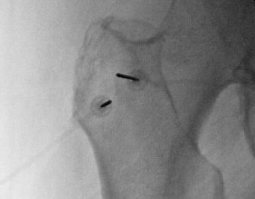 Figure 1 Depicts a posterior view of radiofrequency probe at the left greater trochanter.