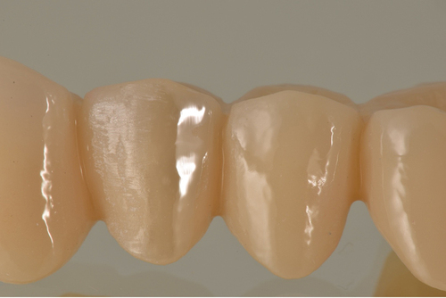 Figure 2. An image demonstrating the facial aspect of a fixed partial denture with one-half of the first pre-molar adjusted and the other half adjusted, finished, and polished.