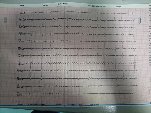 Figure 1 12 Lead electrocardiogram.