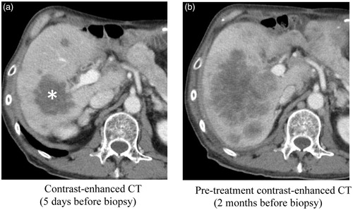 Figure 3. A case of failed NGS analysis. The patient is a man in his 60s with suspected liver metastases from bile duct cancer. (a) Contrast-enhanced CT 5 days before biopsy, after the anticancer medical therapy in a clinical trial. All the tumors demonstrated low attenuation representing hypovascular tumors. The largest mass in the posterior segment of the liver (asterisk) was selected for the target site of biopsy. Biopsy of five cores from various portions in the tumor was performed under ultrasound guidance. NGS analysis failed, and the pathological diagnosis was necrosis of the tumor. (b) Pre-treatment contrast-enhanced CT 2 months before biopsy. The diameters of the liver tumors are larger than that on post-treatment CT (a), and enhancement effects were seen in the periphery of the tumors.