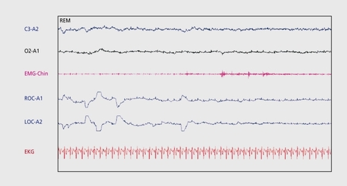 Figure 2. Sleep-onset rapid eye movement (REM) during an mean sleep latency test (MSLT) nap in a patient with narcolepsy. Electroencephalogram (EEG) leads (C3-A2 and 02-A1) demonstrate low voltage mixed frequency theta activity. EMG-Chin shows atonia with phasic events. Electrooculography (EOG) demonstrates REM.