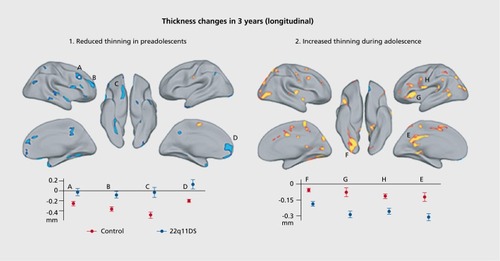 Supplementary Figure 3. Differences in cortical thickness in 22q11.2 DS. Using repeated-measures with the longitudinal subsample, they confirm the different trajectories of cortical thickness changes observed with cross-sectional design. 122 In preadolescents (before 9 of age at Time 1), they observe numerous clusters where no thickness changes occur in patients, whereas thinning is observed in controls. In clusters A to D, this pattern of delayed thinning reaches significance at a threshold of P< 0.007. Contrarily, they observed greater thickness loss in affected adolescents compared with controls (older than 9 at Time 1). This greater thinning with age in patients compared with controls is significant at P< 0.002. Reproduced from ref 122: Schaer M, Debbane M, Cuadra MB, et al. Deviant trajectories of cortical maturation in 22q11.2 deletion syndrome (22q11DS): Across-sectional and longitudinal study. Schizophr Res. 2009;115:182-90. Copyright © Elsevier 2009