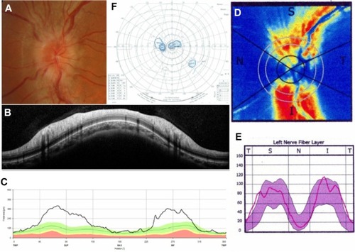 Figure 2 Representative case of optic neuritis.