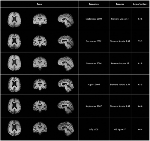 Figure 1. Serial MRI results. *Abbreviation: MRI: Magnetic resonance imaging (MRI). Overview of raw data of MRI scans of the brain which were performed between 2000 and 2009, including scanner type and age at time of performance. At visual inspection there is no progressive atrophy