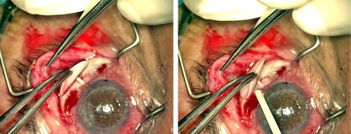Figure 2 Ahmed glaucoma valve: sutureless implantation technique.