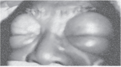 Figure 1 Orbital emphysema: Bilateral massive orbital swellings due to massive orbital emphysema complicating bronchopleural fistula.