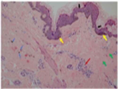 Figure 2. Abdominal skin biopsy findings of the female patient (100X).