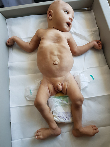 Figure 1 Pectus excavatum, lax abdomen, bilateral cryptorchidism and rocker bottom feet.