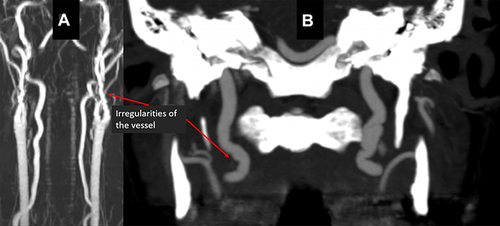 Figure 2 Prominent tortuosity of bilateral vertebral (A) and carotid arteries (A and B) in a patient with fibromuscular dysplasia (FMD).