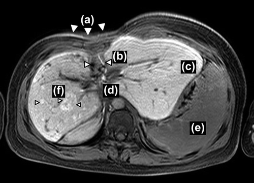 Figure 4. MRI obtained 16 years after the proton beam therapy. Chest wall retardation (a), atrophy of the irradiated liver (b), compensatory hypertrophy of the left lateral lobe (c), portal stenosis (d), splenomegaly (e), multiple focal nodular hyperplasia- (FNH-) like lesions (f).