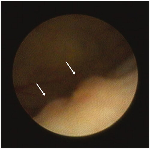 Figure 2. Rat bladder tumors at evaluation by cystoscopy.