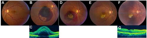 Figure 1 83-year old female with exudative age-related macular degeneration of the right eye. (A) Fundus photograph of the left eye showed macular drusen at the time of presentation. (B) The right fundus photograph revealed large, thick submacular hemorrhage at the time of presentation (SMH). (C) OCT of the right eye from presentation revealed subretinal hemorrhage. (D)At one-month follow-up after receiving intravitreal bevacizumab, there was some resolution of the SMH with persistent dehemoglobinzied blood. (E) Six months later with continuation of anti-VEGF treatment, the hemorrhage had been completely resolved, with inferior subretinal fibrosis that was away from the fovea. (F) At ten-year follow-up, the inferior subretinal fibrosis developed pigmentation; (G) corresponding OCT was stable without subretinal fluid.