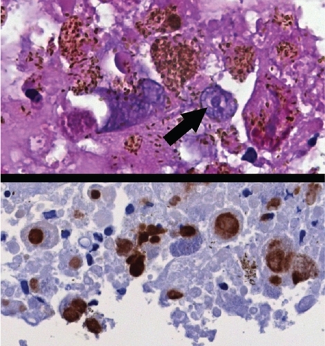 Figure 2 Top: Cell containing an intranuclear inclusion with a surrounding clear halo (arrow) suggestive of CMV infection (original magnification 640x). Bottom: CMV immunohistochemical stain of the retinal biopsy showing positivity in the nuclei and intranuclear inclusions (original magnification 640x).