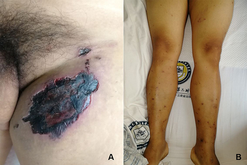 Figure 1 Skin lesions. (A) A black necrotic eschar, about 3×7 cm, in the center of the redness and swelling at the left thigh root. (B) The lower limbs are scattered with erythema and necrotic crusts.
