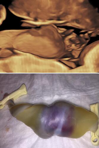 Figure 7 Upper panel: Three-dimensional sonography of the umbilical vein thrombosis. Lower panel: Umbilical vein thrombosis immediately following emergency Cesarean for prolonged fetal bradycardia at 37 weeks’ gestation.