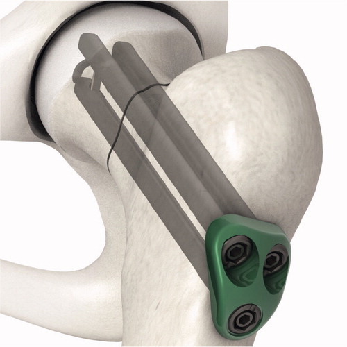 Figure 1. Hansson Pinloc System.