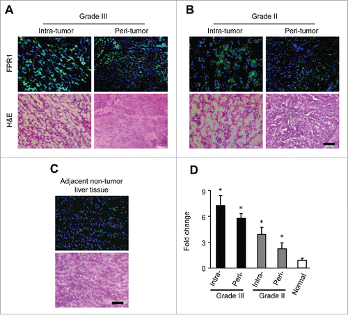 Figure 1. FPR1 expression in human hepatocellular carcinoma tissues. Sections of 20 samples from grade III (A) and II (B) hepatocellular carcinoma and 10 samples of adjacent normal liver tissues (C) were stained with an antibody against FPR1 (green) and counterstained with DAPI (blue). Representative intratumor (upper panels) and peritumor (lower panels) immunofluorescence staining (left panels) and corresponding H&E staining (right panels) are shown. Bar = 100 μm. (D), quantitative PCR analysis showing the level of FPR1 gene in intratumor or peritumor tissues of grade III and II hepatocellular carcinoma and adjacent normal liver tissues. The data was shown as the mean-fold changes of FPR1 expression levels (± SEM) after intra-sample normalization to the levels of GAPDH. * p <0.05, statistically significant difference vs. adjacent normal liver tissues in values.
