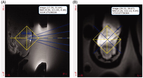 Figure 3. (A) Transverse and (B) coronal image planning snapshot from the user interface. The yellow crosshairs denote the user-selected location for target heating, and the blue overlay shows the current focus of the transducer. The platform controls a motorized system and moves the transducer to the required location. The interface provides a legend on the images, with the coordinates of the cursor relative to the lower-left corner of the image (top), the absolute MRI coordinates using the right-anterior-superior (RAS) convention (middle) and the magnitude of the pixel (bottom). In this example, the cursor was located at the focal location in each image orientation.