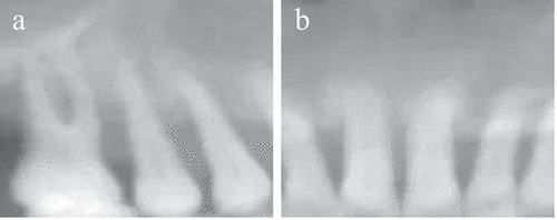 Figure 3. CBCT images of the maxillary dental zone. (Figure 3(a) was of the maxillary posterior zone, while Figure 3(b) was of the maxillary anterior zone.).