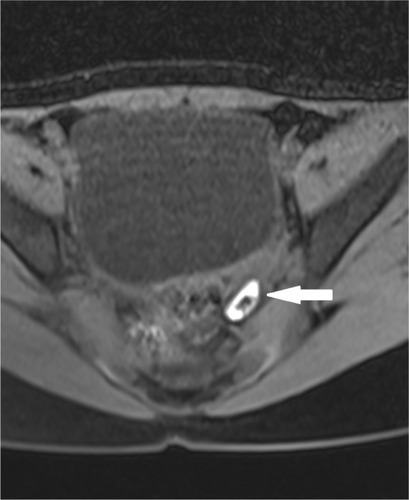 Figure 4 Axial fat suppressed T1-weighted image showing oval hyperintense lesion with thick central calcification in the left adnexa (arrow).
