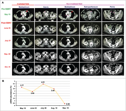 Figure 2. Tumor regressed after the combined treatment with RT and pembrolizumab. A. On June 25, 2016 (a month after starting treatment with RT), an enhanced CT scan showed the dramatically decreased volumes of tumors, compared with the images before combined treatment (May 18, 2016), not only in irradiated field but also in non-irradiated fields; more importantly, the CT scan images on July 27, 2016 demonstrated that all metastases, including the mass in the RT field and other metastatic lesions out of the RT fields, had completely resolved, consistent with a systemic complete response by RECIST criteria. B. The first detection of ctDNA abundance in May 18, 2016 showed 3.77% (ctDNA abundance = ctDNA in peripheral blood / total free DNA in peripheral blood); there was a remarkable decrease of ctDNA abundance (2.28%) measured in June 23, 2016; and only 0.38% ctDNA abundance could be detected in Sep. 14, 2016.