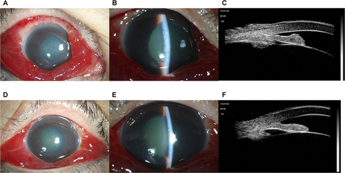 Figure 4 A 59-year-old woman presented to our clinic with complaints of reduced visual acuity, ocular pain, nausea, and vomiting in both eyes one day after COVID-19 inflection. (A and B): Slit lamp images showed obvious conjunctival hyperemia and hemorrhage, corneal epithelial and stromal edema, enlarged pupil, and shallow anterior chamber in right eye. (C): Ultrasound biomicroscopy images showed iris trabecular contact, closed angle, and shallow anterior chamber in the same eye. (D–F): The patient experienced the same APAC attack in the left eye simultaneously.