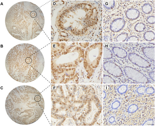 Figure 3 The level of mono-ADP-ribose binding reagent in colorectal adenocarcinoma and normal colorectal tissues. Positive staining of mono-ADP-ribose binding reagent in colorectal adenocarcinoma (A–C) (×4), (D–F) (×400). Positive staining of mono-ADP-ribose binding reagent in normal colorectal tissue (G–I) (×400). Scale bar=50μm.