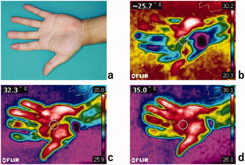 Figure 3. Clinical photography of the patient’s left hand at 3 years follow-up showing (a) the replanted index finger and the middle finger reconstructed using a free flow-through hypothenar flap. Cold stress test thermography; (b) immediately after immersion in cold water, (c) 1 min post immersion and (d) 2 min post immersion.