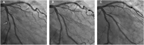 Figure 1 Representative coronary angiography (CAG) images of late lumen enlargement after drug-coated balloon (DCB) treatment for de-novo coronary artery lesions exceeding 2.5 mm in diameter. CAG images before the percutaneous coronary intervention procedure (A), immediately after the DCB was used (B), and at 7 months of follow-up (C). The white arrow refers to severe stenosis of the left circumflex artery shown on CAG.