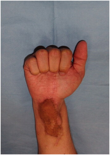 Figure 5. Appearance of the right wrist 1 year and 10 months after surgery.