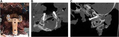 Figure 6 (A) This picture shows anterior occipital condyle screw and plate fixation in cadaveric specimen. Axial (B) and sagittal (C) views of the CT scan of anterior occipital condyle screw fixation in cadaveric specimen, and the hypoglossal canal was not injured by screw.