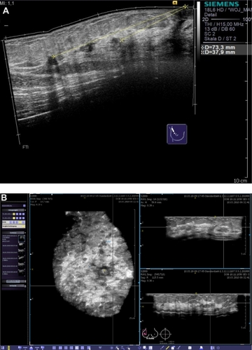 Figure 8 Clinical example of multifocal breast cancer. With conventional ultrasound, even when using techniques such as SieScape® panoramic imaging, it is difficult to display more than three lesions at the same time (A). In the coronal plane, derived from the volume data sets, all foci can be viewed at the same time (B). While remaining aware of the extension of tissue changes, we planned a quadrantectomy after wire localization.