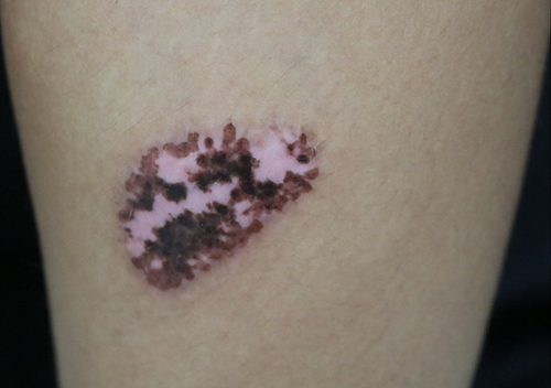 Figure 1 Segmental lentigines in patient with Fitzpatrick skin type IV after single session of Q-switch neodymium-doped yttrium aluminum garnet (532 nm) on lower part of the lesion, notice the postinflammatory hyperpigmentation that occur on the lower half of the lesion.