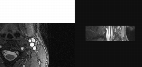 Figure 1. 3D TrueFISP imaging of the carotid artery of a normal volunteer acquired axially and the multi‐planar reconstruction along the direction of the vessel.