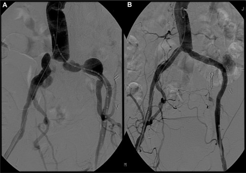 Figure 3 Revascularization of aneurysmal common iliac arteries with covered stents.