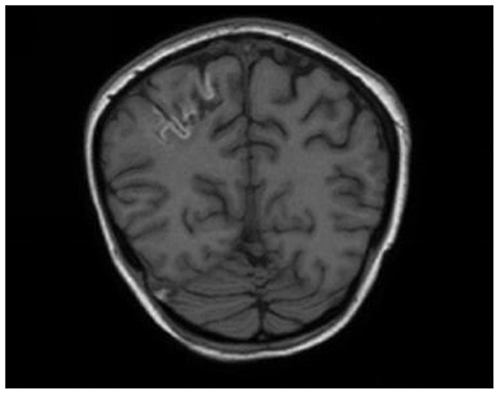 Figure 3 Magnetic resonance imaging T1 weighted image, without contrast, hyperintensity in the right parietal lobe; there is also hyperintense thrombus in the right transverse sinus.