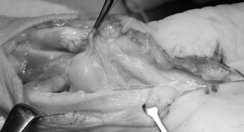 Figure 5.  Photograph during an open repair surgery showed the granulation tissue around the flexor tendons on the volar side of the right forearm.