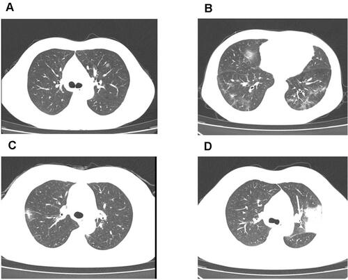 Figure 1 Chest CT images findings for four patients. (A) Chest computed tomography (CT) images of a 42-year-old male patient with COVID-19 taken on August 9, 2020, showing left lung pure GGO. (B) Chest CT images of a 54-year-old male patient with COVID-19 taken on August 9, 2020, showing GGO with reticular and interlobular septal thickening in both lungs. (C) Chest CT images of a 40-year-old female patient with COVID-19 taken on April 21, 2020, showing unilateral GGO with consolidation. (D) Chest CT images of a 33-year-old male patient with COVID-19 taken on April 27, 2020, showing left lung consolidation.