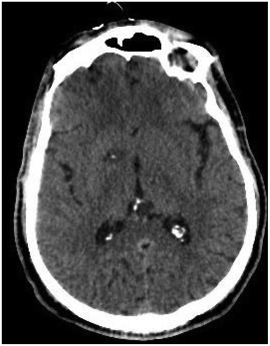 Figure 2. Shows a small-sized right hemispheric infarct with a pin-point hemorrhagic transformation