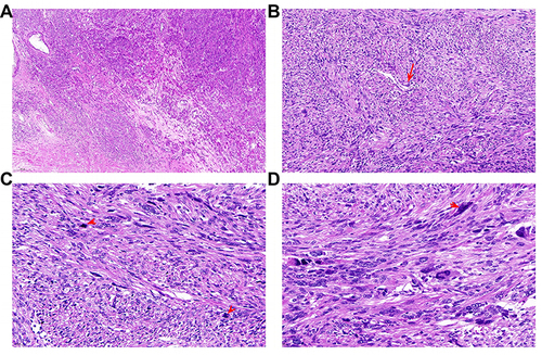 Figure 3 Classic morphological characteristics of smooth muscle tumors of uncertain malignant potential (STUMP). (A) Infiltrative margins. (B) Vascular intrusion (red arrow). (C) Atypical mitoses (red arrows). (D) Nuclear atypia (red arrow).