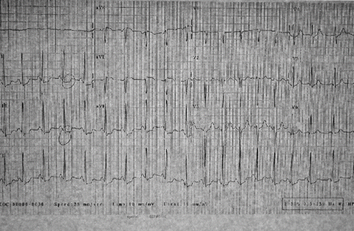 Fig. 1. Post-intubation ECG showing inferior ST segment depression.