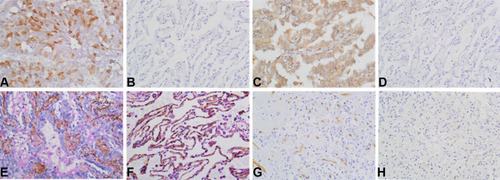 Figure 1 Immunostaining of UBE2C, AGGF1, VM and MVD in NSCLC and control tissues. (A) Positive staining of UBE2C in NSCLC tissues (×400). (B) Negative staining of UBE2C in control tissues (×400). (C) Positive staining of AGGF1 in NSCLC tissues (×400). (D) Negative staining of AGGF1 in control tissues (×400). (E) Positive staining of VM in NSCLC tissues (×400). (F) Negative staining of VM in control tissues (×400). (G) High MVD in NSCLC tissues (×400). (H) Low MVD in control tissues (×400).