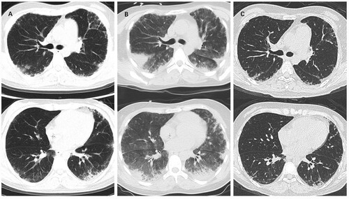 Figure 1. Chest CT images showing the dynamic changes in interstitial lung disease. A: on the 2nd day; B: on the 9th day; C: before discharge.