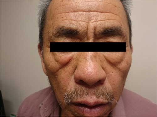 Figure 5 Postoperative facial photo of patient.