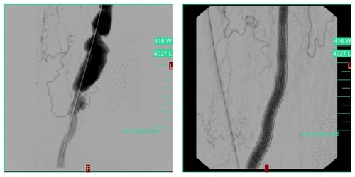 Figure 7 Degeneratively altered femoropopliteal venous bypass on right following acute reopening with rotation thrombectomy (Rotarex® 8 F).