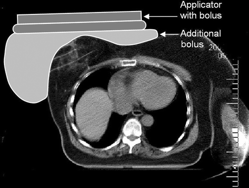 Figure 9. Example of clinical application. CT-slice of the breast with a schematic representation of applicator and additional bolus. The applicator and bolus are kept in position using a belt around the thorax. Note the two catheter tracks in the breast for placement of thermocouple probes (third track not visible in this CT-slice).